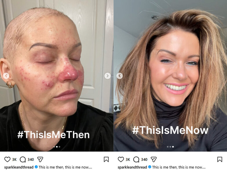 2 photos from Instagram. On the left, a woman with shaved head and closed eyes during chemotherapy with the caption "#This Is Me Then". On the right, a woman with long hair, smiling, with the caption "# This Is Me Now"