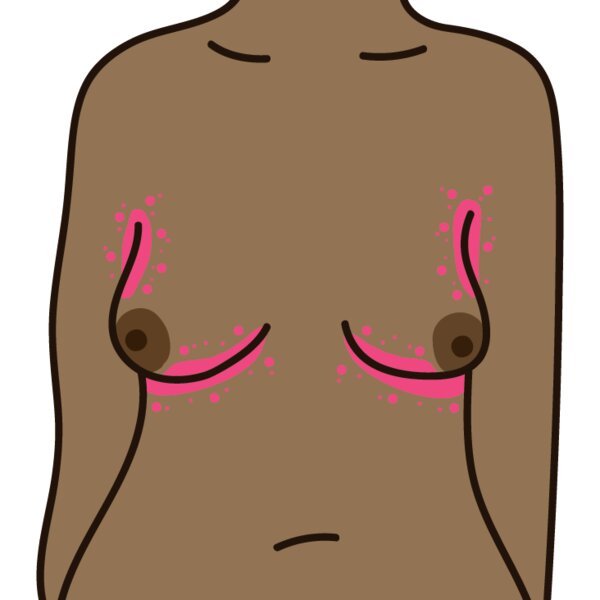 An illustration of intertrigo, showing a torso with a rash under the breasts and armpits.