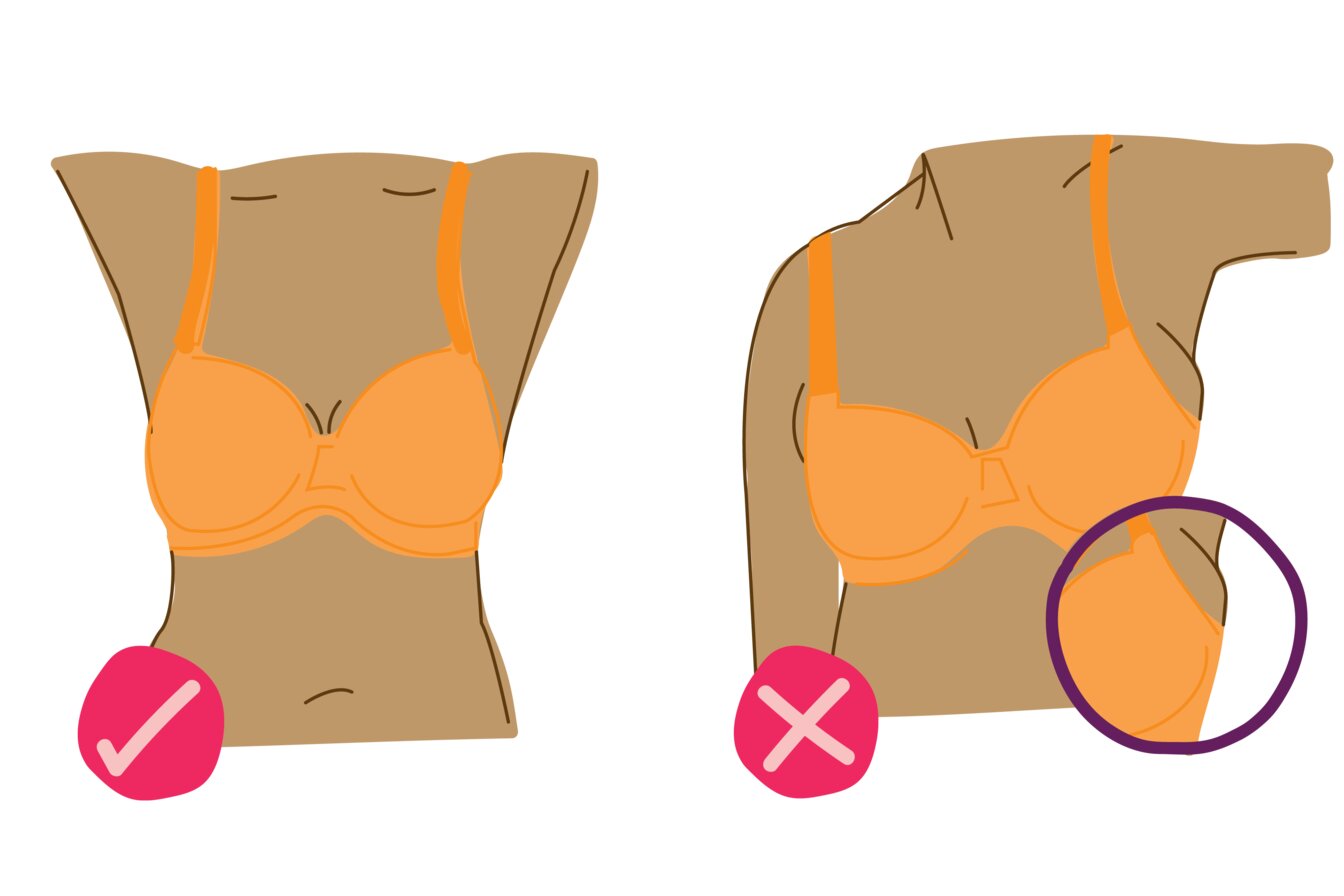 The underwires shouldn’t dig into any breast tissue, particularly under your arm.