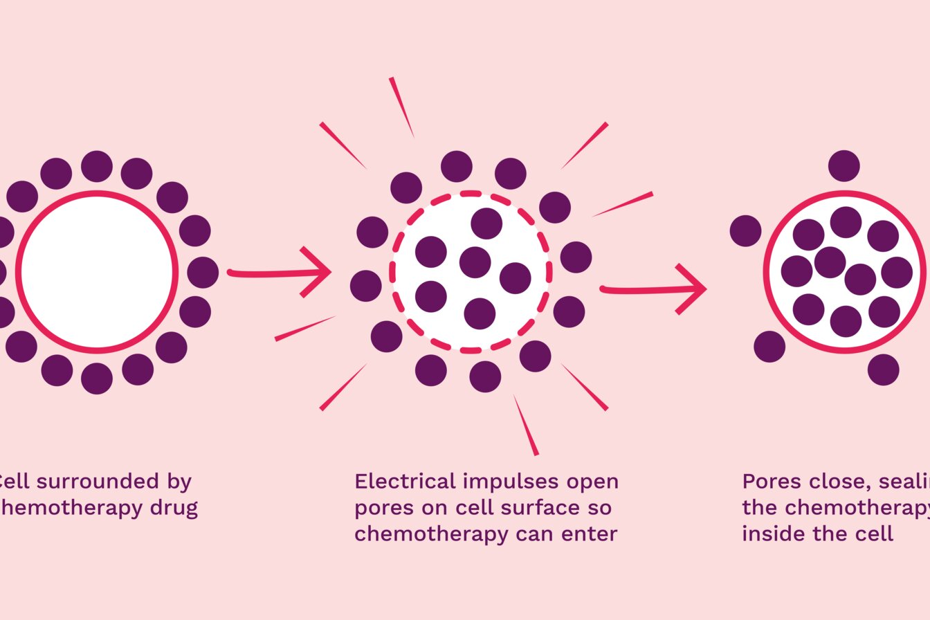 An illustration of electrochemotherapy in action.*