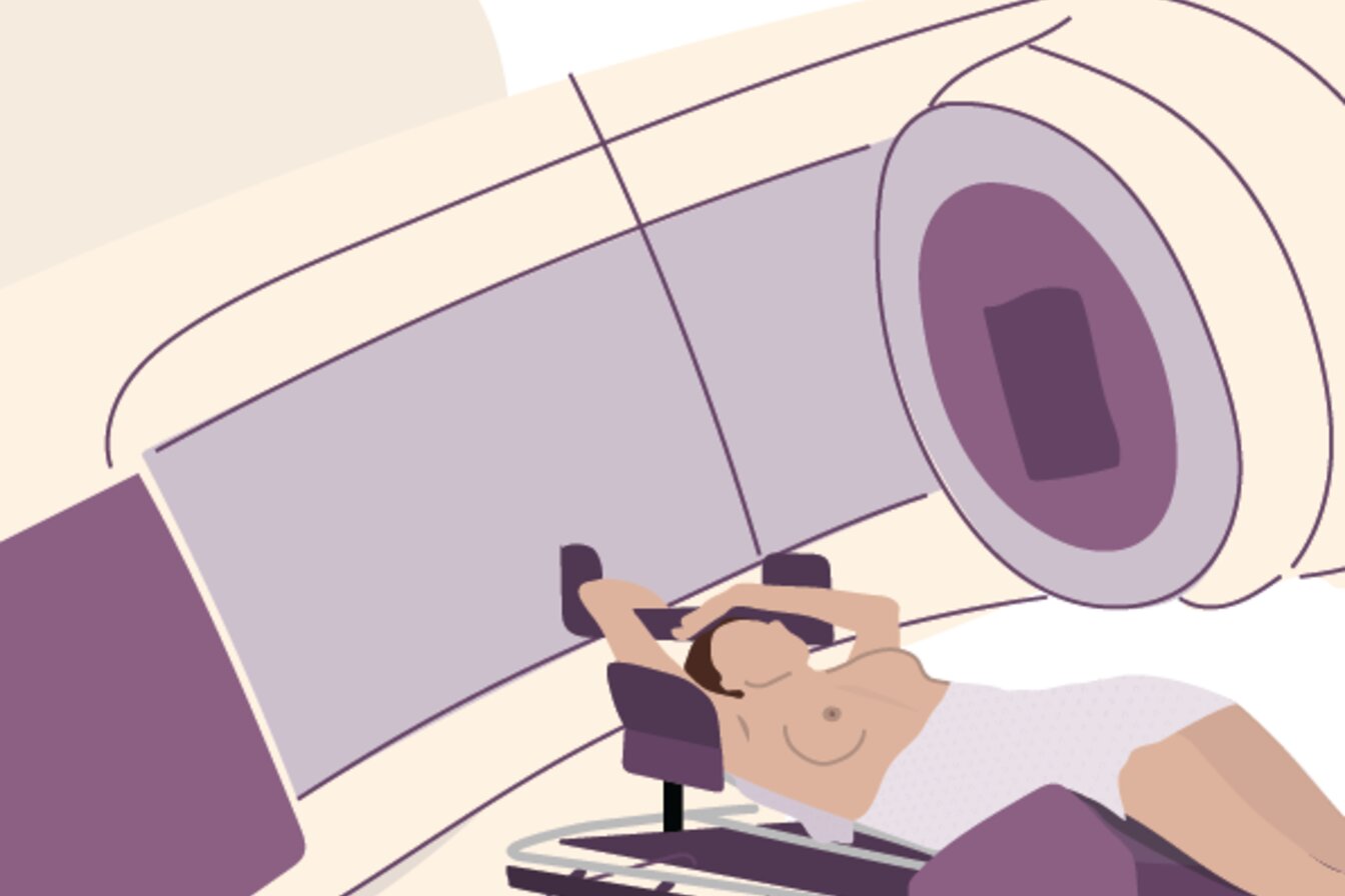 An illustration of a person having breast radiotherapy
